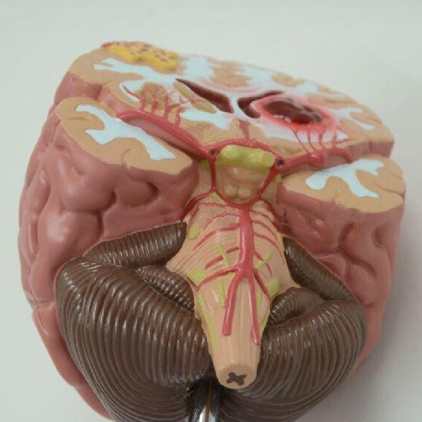 Human Brain Anatomical Model Showing Cerebral Diseases / Cerebral Heamorrhage - Psych Outlet